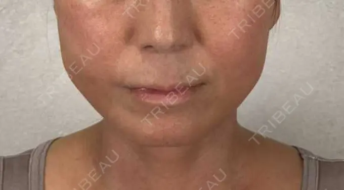 糸リフト / ボトックス（エラ・小顔） / ピーリング（ハリ・ツヤ） アリエル美容クリニック 横浜院 DAY 7 メイン用