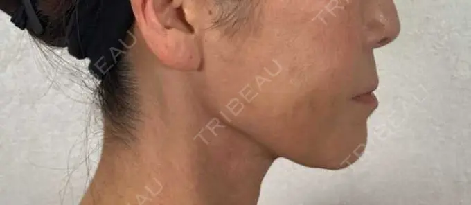 糸リフト / ボトックス（エラ・小顔） / ピーリング（ハリ・ツヤ） アリエル美容クリニック 横浜院 DAY 7 メイン用