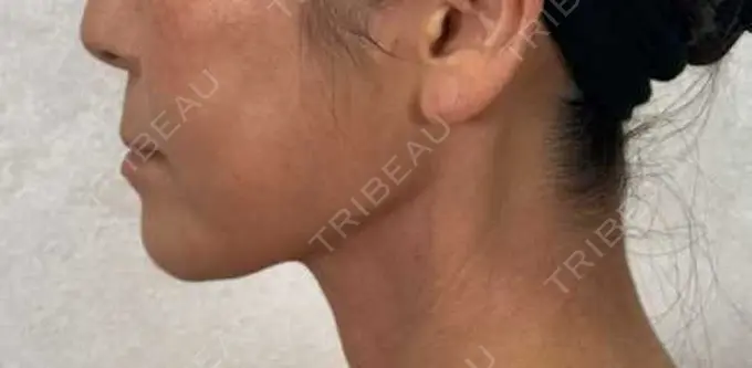 糸リフト / ボトックス（エラ・小顔） / ピーリング（ハリ・ツヤ） アリエル美容クリニック 横浜院 DAY 7 メイン用