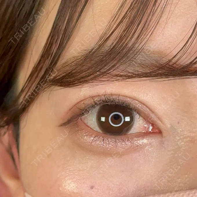 二重埋没 / 目頭切開 アリエル美容クリニック 郡山院 AFTER メイン用