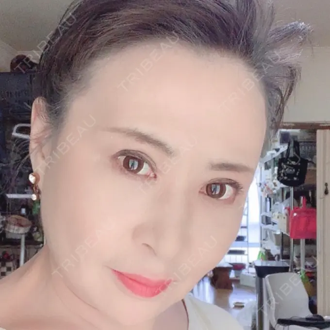 糸リフト / 下まぶたの脂肪取り / 脂肪注入（輪郭） / その他（目元） 湘南美容クリニック 橋本院 AFTER メイン用