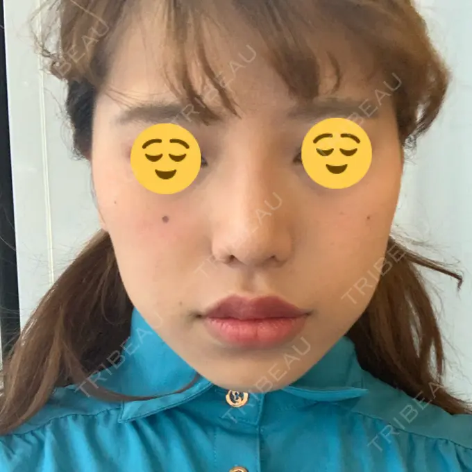 隆鼻術 / 鼻尖形成（切開） / 小鼻縮小（切開） / 軟骨移植 湘南美容クリニック 新橋銀座口院 DAY 46 メイン用