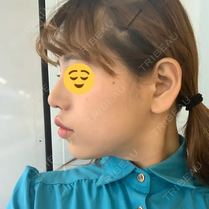 隆鼻術 / 鼻尖形成（切開） / 小鼻縮小（切開） / 軟骨移植 湘南美容クリニック 新橋銀座口院 DAY 46 メイン用