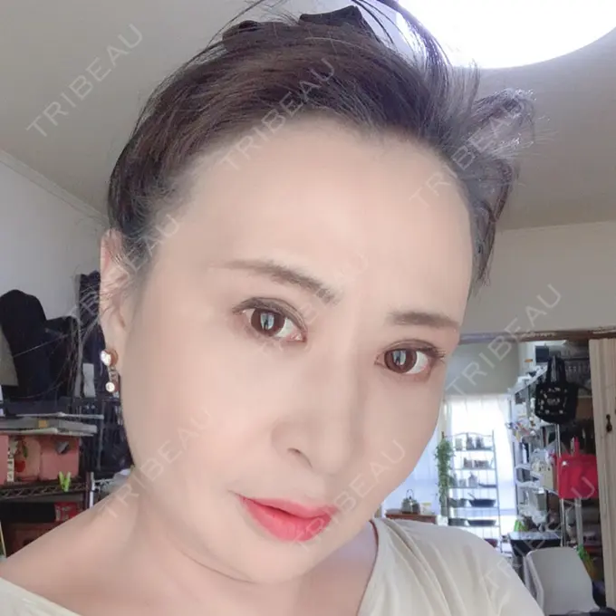 糸リフト / 下まぶたの脂肪取り / 脂肪注入（輪郭） / その他（目元） 湘南美容クリニック 橋本院 DAY 121 メイン用