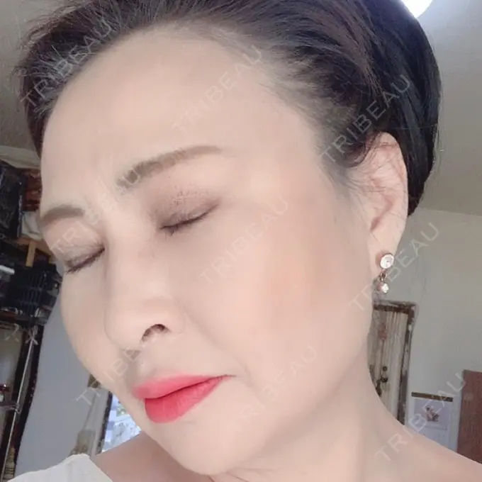 糸リフト / 下まぶたの脂肪取り / 脂肪注入（輪郭） / その他（目元） 湘南美容クリニック 橋本院 DAY 121 メイン用