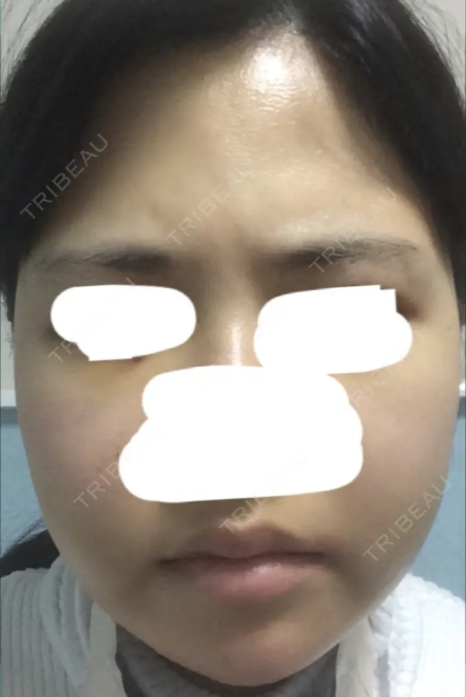 脂肪吸引（顔） T.O.P整形外科 DAY 31 メイン用