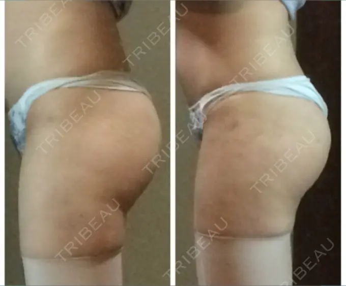 脂肪吸引（脚） T.O.P整形外科 DAY 31 メイン用