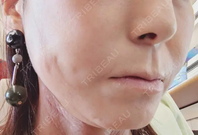 糸リフト / ボトックス（エラ・小顔） / ピーリング（ハリ・ツヤ） アリエル美容クリニック 横浜院 DAY 10 メイン用