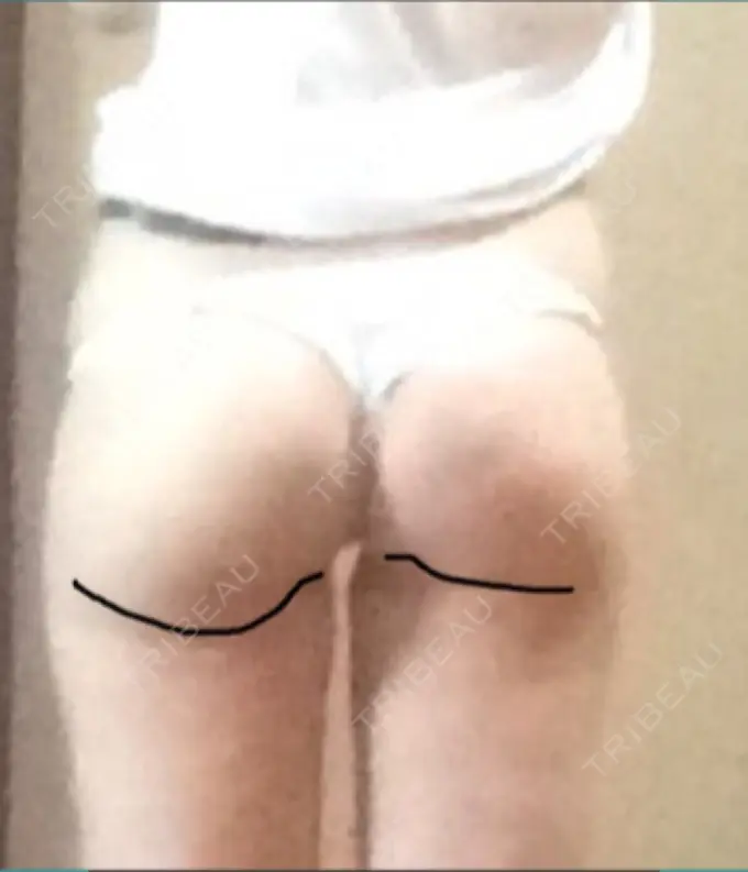 脂肪吸引（脚） T.O.P整形外科 DAY 31 メイン用