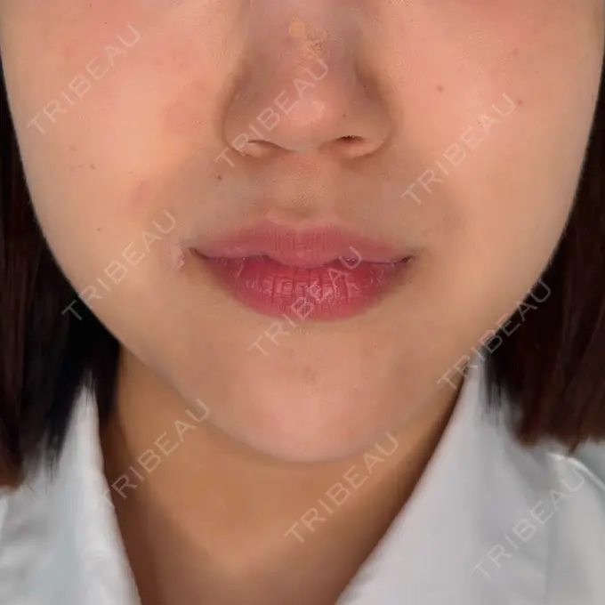 ボトックス（エラ・小顔） / ボトックス（肩） HAAB BEAUTY CLINIC 名古屋院 DAY 0 メイン用