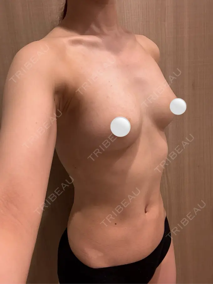 脂肪吸引（お腹） / 豊胸（脂肪注入） / 脂肪吸引（背中） ルーチェクリニック 銀座院 DAY 32 メイン用