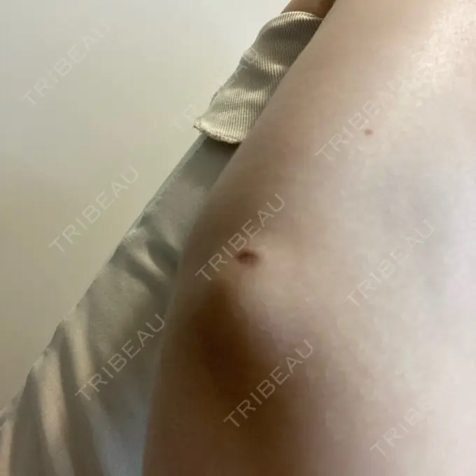 脂肪吸引（顔） / 脂肪吸引（二の腕） / 医療痩身（お腹） / 脂肪吸引（腰） / 脂肪吸引（肩） Mods Clinic（モッズクリニック） 福岡院 DAY 179 メイン用