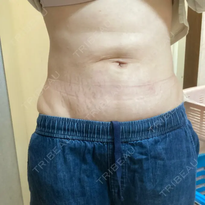 脂肪吸引（顔） / 脂肪吸引（二の腕） / 医療痩身（お腹） / 脂肪吸引（腰） / 脂肪吸引（肩） Mods Clinic（モッズクリニック） 福岡院 DAY 179 メイン用