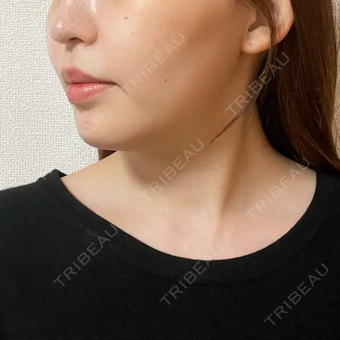 ボトックス（エラ・小顔） もとび美容外科クリニック 新宿院 DAY 0 メイン用