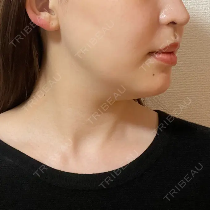 ボトックス（エラ・小顔） もとび美容外科クリニック 新宿院 DAY 0 メイン用