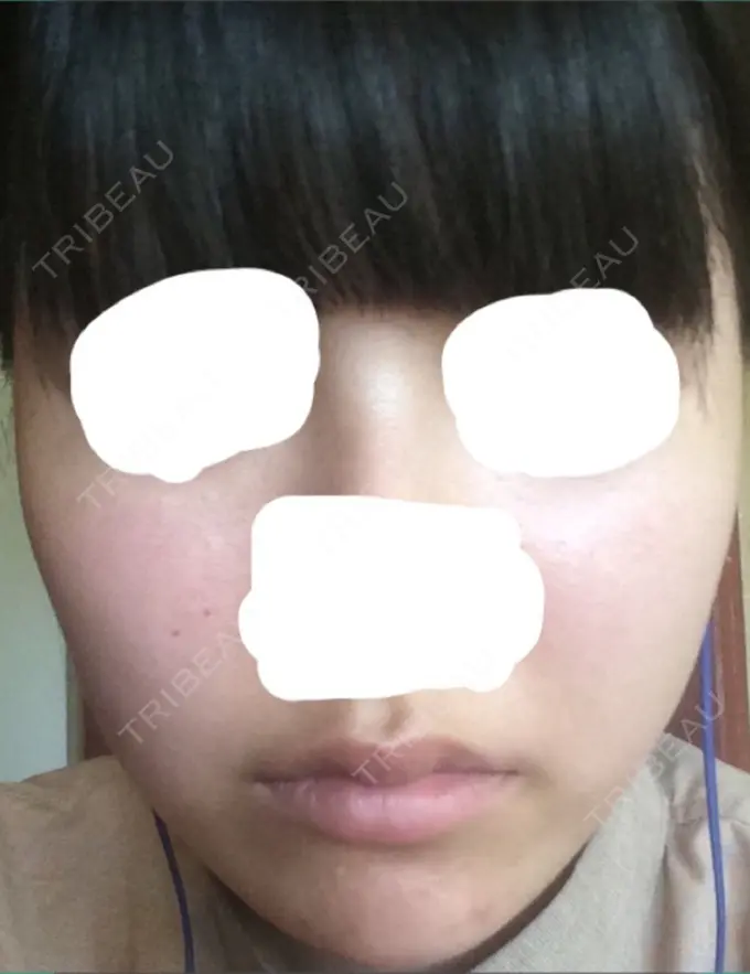 脂肪吸引（顔） T.O.P整形外科 DAY 31 メイン用