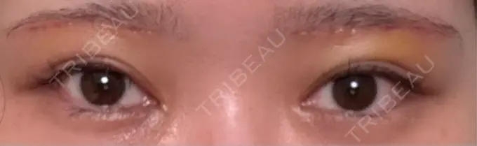 眉下切開 もとび美容外科クリニック 新宿院 DAY 8 メイン用