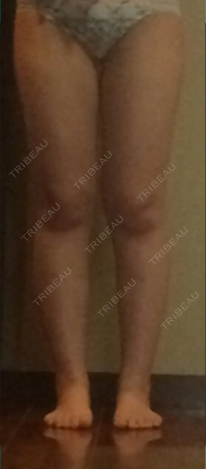 脂肪吸引（脚） T.O.P整形外科 DAY 31 メイン用