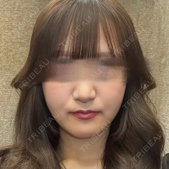 骨切り（あご） 銀座マイアミ美容外科 AFTER メイン用