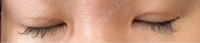 二重埋没 水の森美容クリニック 東京銀座院 DAY 10 メイン用