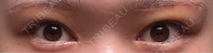 眉下切開 もとび美容外科クリニック 新宿院 AFTER メイン用