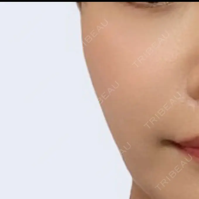 肌育注射（ジュベルックなど） / その他（肌） ゆきスキンクリニック 東池袋 AFTER メイン用