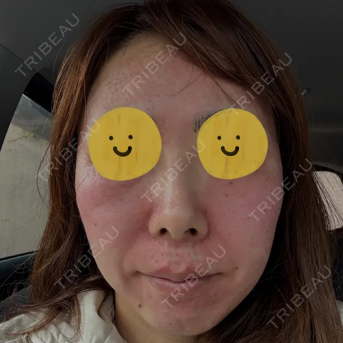 リジュラン しんゆり美容健康クリニック DAY 0 メイン用