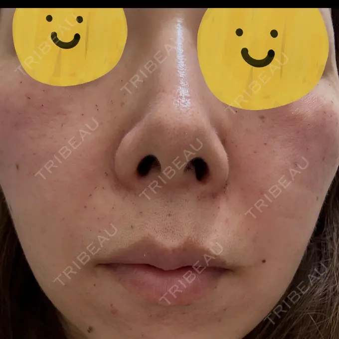 リジュラン しんゆり美容健康クリニック DAY 0 メイン用