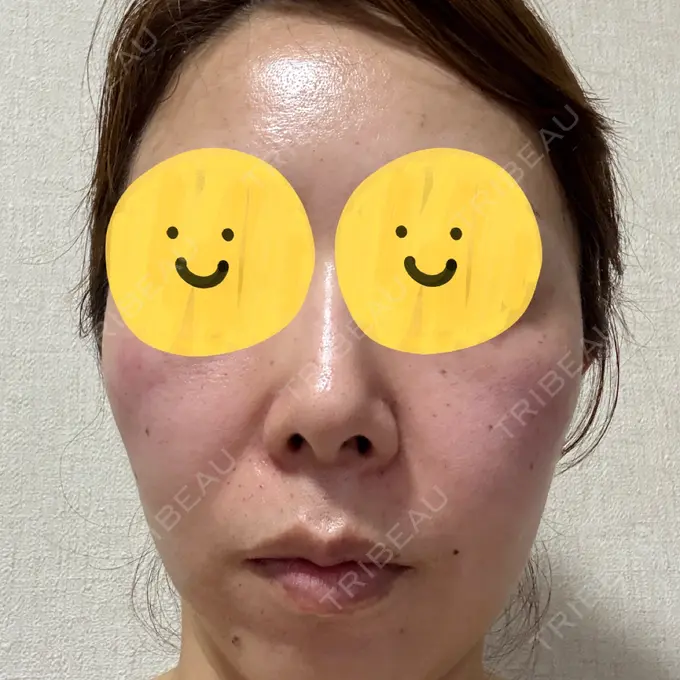 リジュラン しんゆり美容健康クリニック DAY 0 メイン用