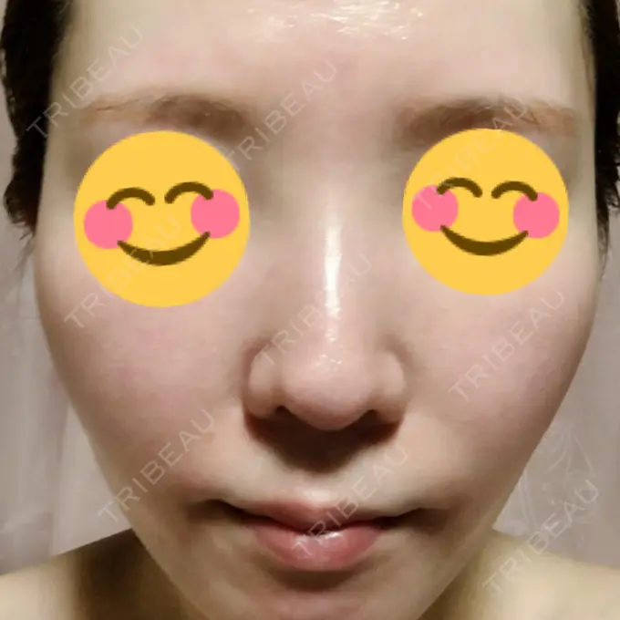 美肌レーザー みやた形成外科・皮ふクリニック DAY 12 メイン用