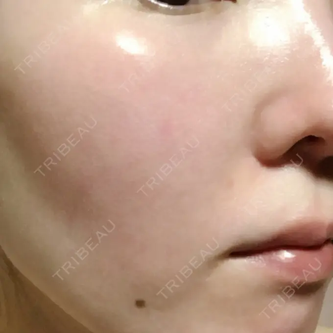 美肌レーザー みやた形成外科・皮ふクリニック DAY 12 メイン用