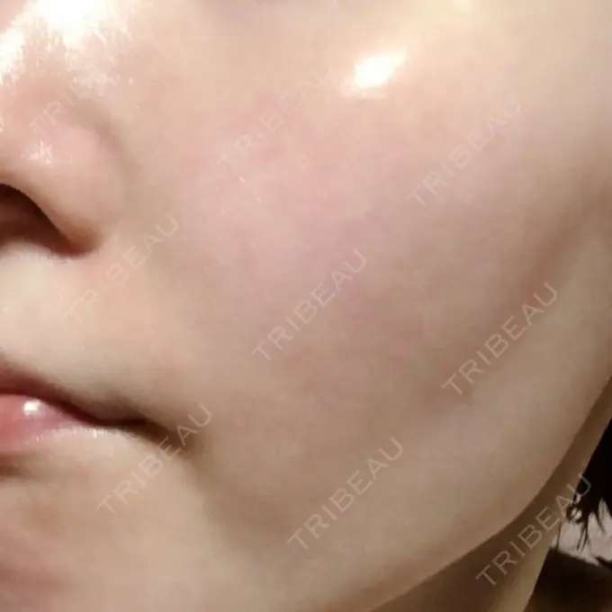 美肌レーザー みやた形成外科・皮ふクリニック DAY 12 メイン用