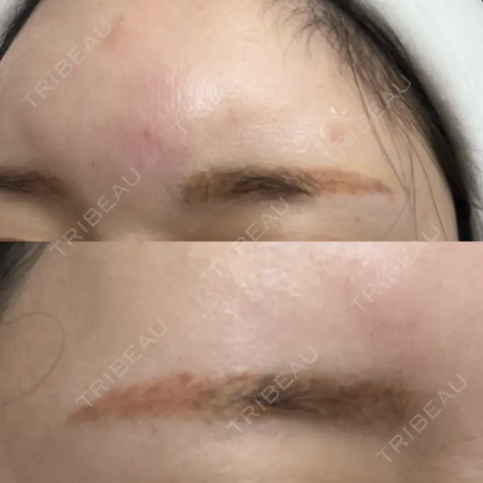 アートメイク（眉） / アートメイク除去・修正 表参道メディカルクリニック 横浜院	 DAY 1 メイン用