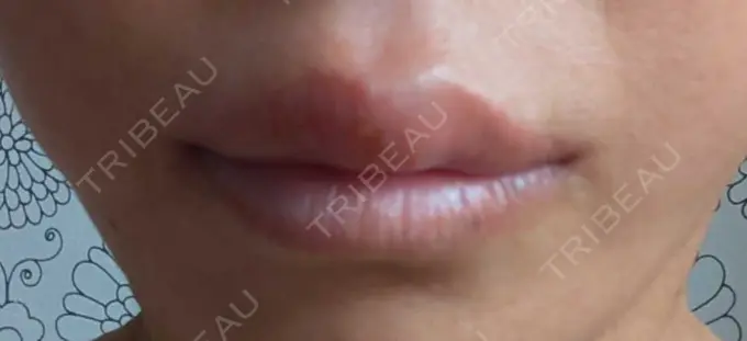 アートメイク（唇） TRUE DESIGN CLINIC DAY 2 メイン用