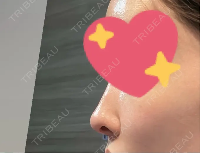 軟骨移植 吉祥寺アイビークリニック DAY 7 メイン用