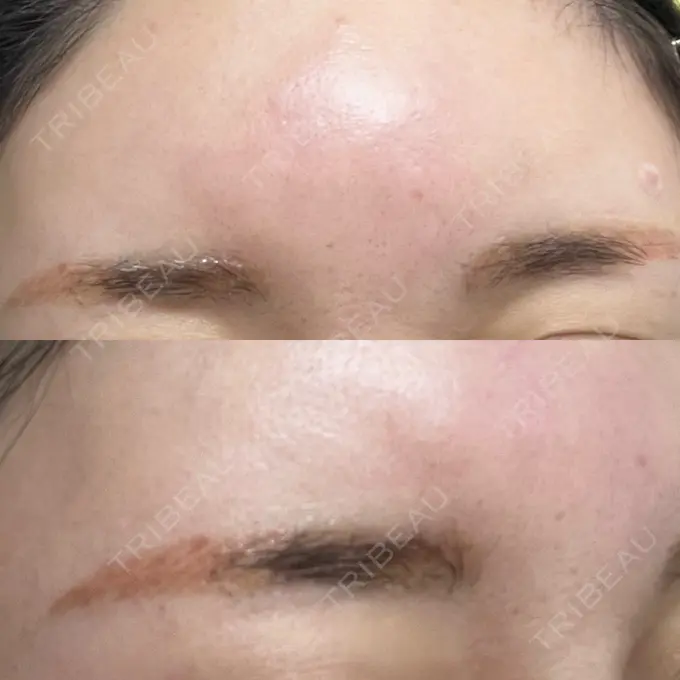 アートメイク（眉） / アートメイク除去・修正 表参道メディカルクリニック 横浜院	 DAY 2 メイン用