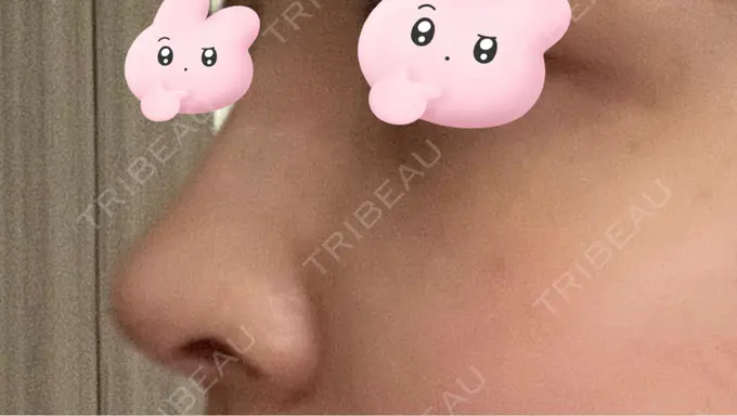 軟骨移植 吉祥寺アイビークリニック DAY 8 メイン用