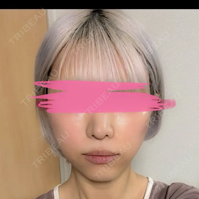 クマ治療 / 脂肪注入（額） / 脂肪注入（輪郭） X CLINIC 名古屋院 DAY 365 メイン用