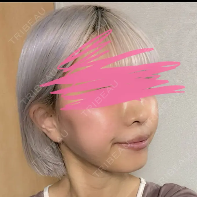 クマ治療 / 脂肪注入（額） / 脂肪注入（輪郭） X CLINIC 名古屋院 DAY 365 メイン用