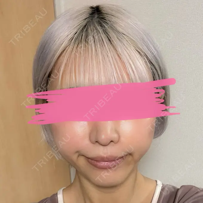 クマ治療 / 脂肪注入（額） / 脂肪注入（輪郭） X CLINIC 名古屋院 DAY 365 メイン用