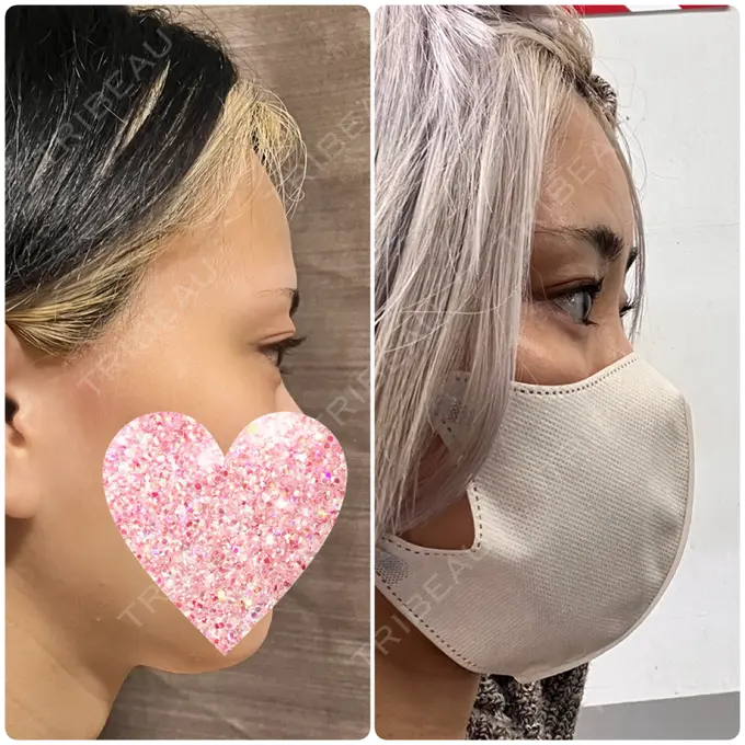 クマ治療 / 脂肪注入（額） / 脂肪注入（輪郭） X CLINIC 名古屋院 AFTER メイン用