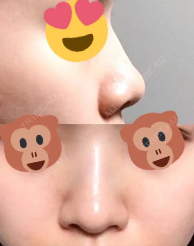 ヒアルロン酸注入（鼻） / ヒアルロン酸注入（あご） 恵聖会クリニック 京橋院 AFTER メイン用