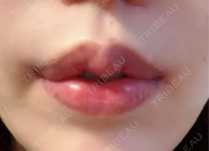 人中短縮 / 口角挙上 / その他（口元） R Beauty CLINIC 銀座院 AFTER メイン用