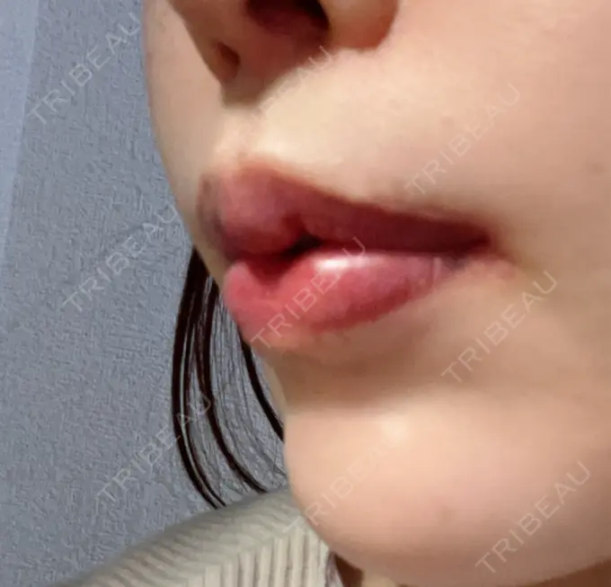 人中短縮 / 口角挙上 / その他（口元） R Beauty CLINIC 銀座院 DAY 105 メイン用