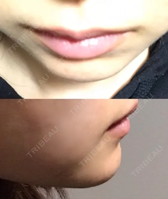 ヒアルロン酸注入（鼻） / ヒアルロン酸注入（あご） 恵聖会クリニック 京橋院 DAY 11 メイン用