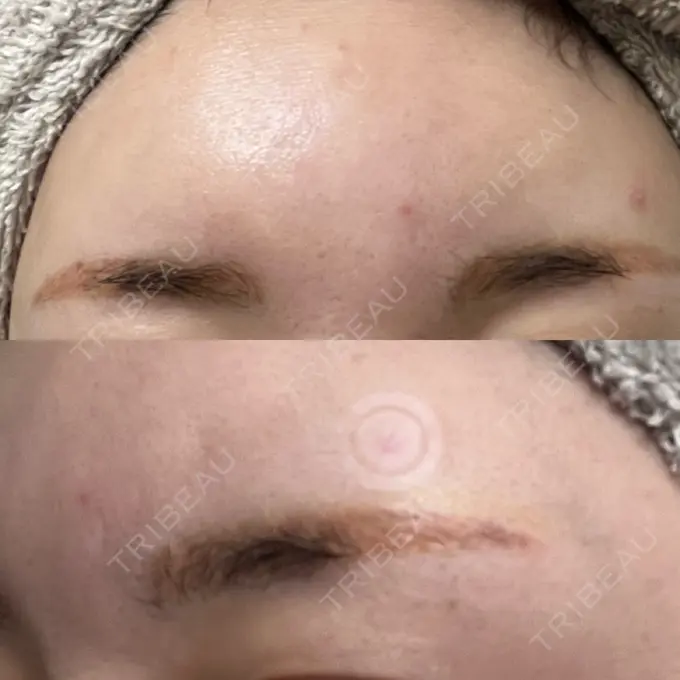 アートメイク（眉） / アートメイク除去・修正 表参道メディカルクリニック 横浜院	 DAY 3 メイン用