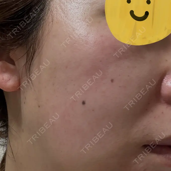 リジュラン しんゆり美容健康クリニック DAY 1 メイン用