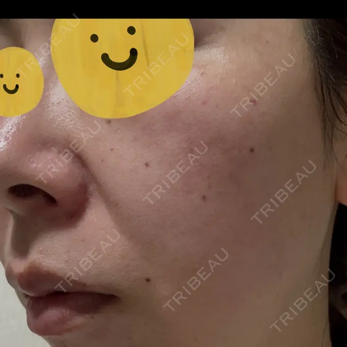 リジュラン しんゆり美容健康クリニック DAY 1 メイン用