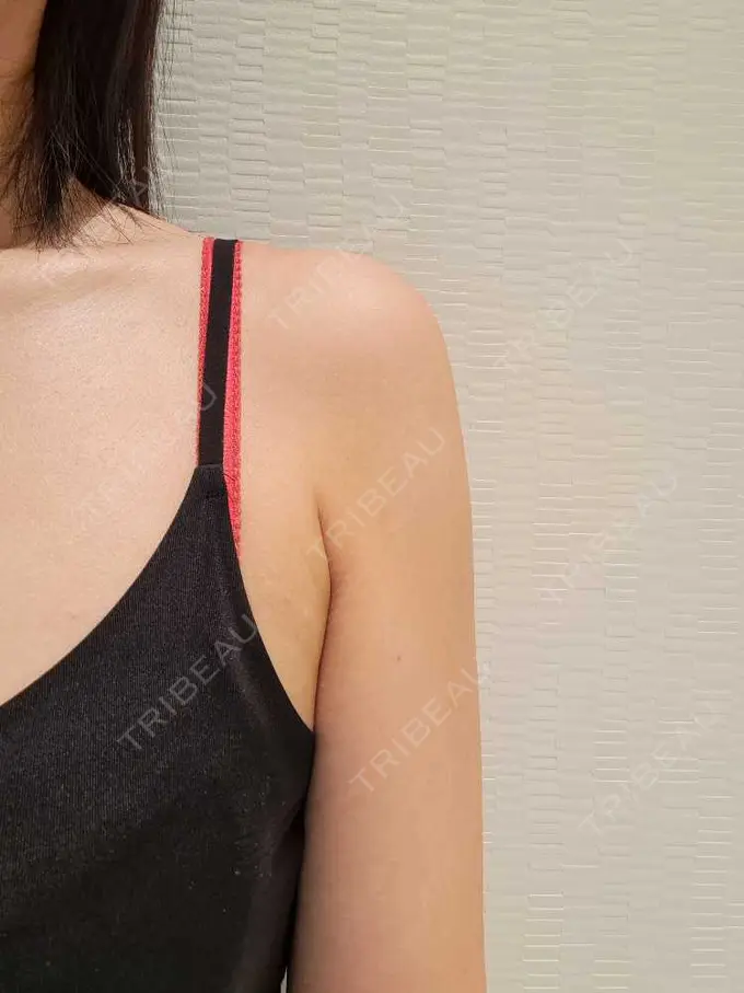 クマ治療 / 脂肪吸引（顔） / 脂肪吸引（二の腕） / 脂肪吸引（肩） / 脂肪注入（目の下） Mods Clinic（モッズクリニック） 名古屋院 DAY 90 メイン用