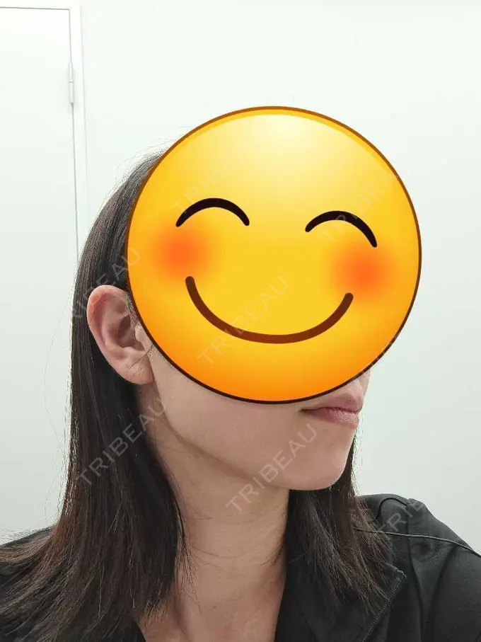 クマ治療 / 脂肪吸引（顔） / 脂肪吸引（二の腕） / 脂肪吸引（肩） / 脂肪注入（目の下） Mods Clinic（モッズクリニック） 名古屋院 DAY 90 メイン用